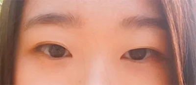 비절개 매몰 쌍커풀 수술 후기!