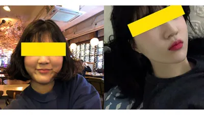 안면윤곽  - 광대축소술 했어요!