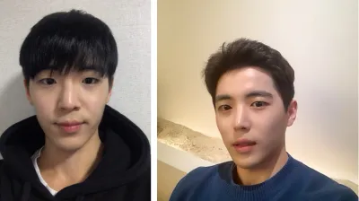 눈매교정이랑 트임, 코수술했습니다.