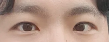 남자 눈매교정(앞트임포함, 절개)했어요~!!