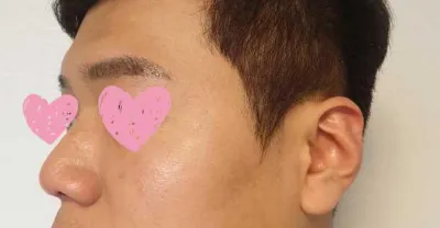 콧대, 코끝, 복코교정, 매부리