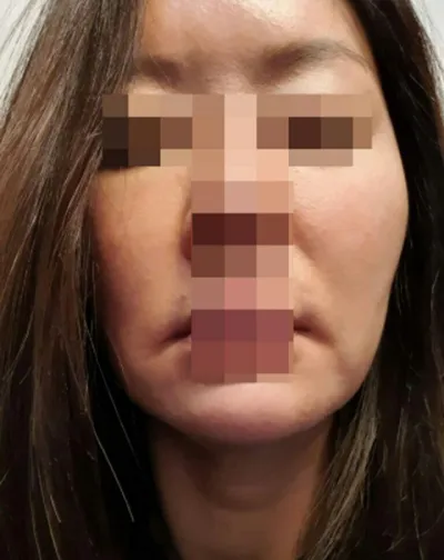 눈밑지방이식, 안면거상술