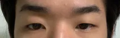 쌍꺼풀(부분절개), 눈매교정, 앞트임