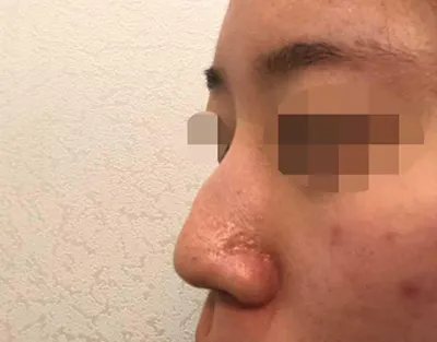 수술 받은 지 4개월 후의 후기를 남깁니다!! ᄒᄒᄒ