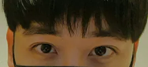 쌍꺼풀(절개), 눈매교정, 라인낮추기