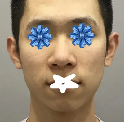 남자 코,윤곽 성형 후기 남깁니다