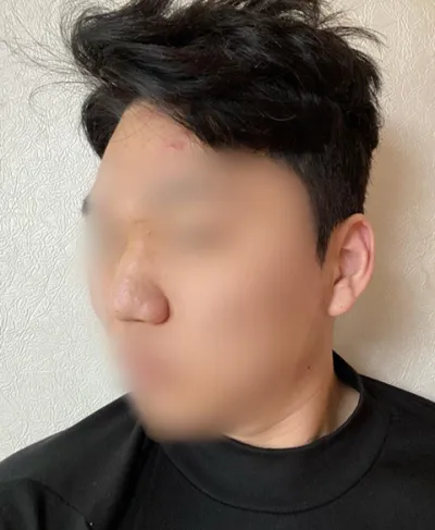 콧대, 코끝, 복코교정, 코뼈축소