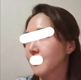 안면거상 재수술 받고 옛사진보니 뿌듯^^