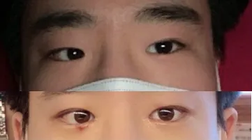 쌍꺼풀(매몰), 앞트임