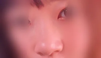 제이준성형외과에서 코 필러 맞았어요:)