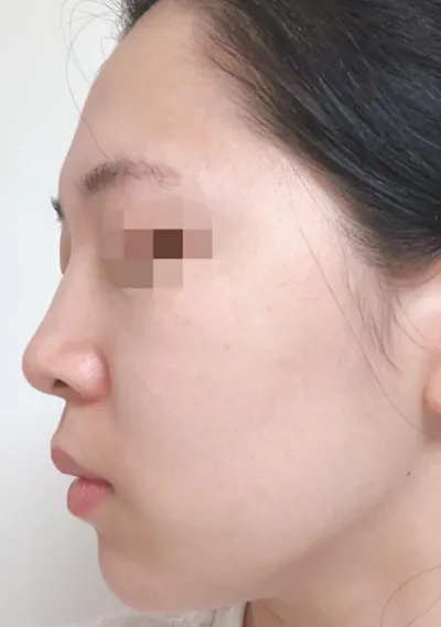 풀페이스 지방이식 + 코필러 10일차 입니다.