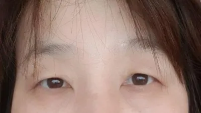 눈매몰 하안검 상안검 했어요