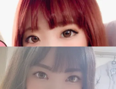 쌍꺼풀(매몰), 앞트임