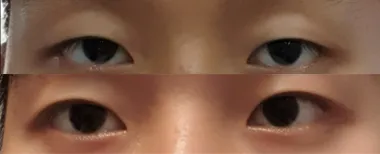 #비절개눈매교정