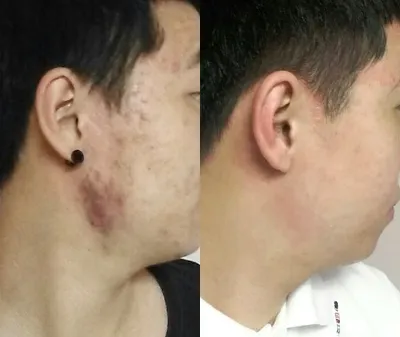 여드름치료 6개월 후기