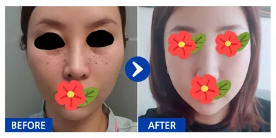 [바비톡] 안면윤곽, 눈밑지방재배치 / 2개월차/ 닉네임: 얌얌얌얌123