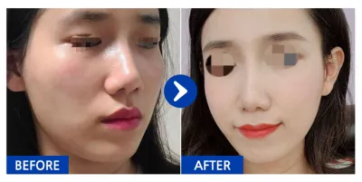 [바비톡] 안면윤곽 / 3개월차 / 닉네임 : dbdbdla