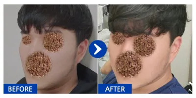 [바비톡] 안면윤곽 / 3개월차 / 닉네임: 안능웅