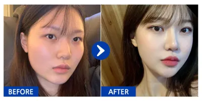 [바비톡] 안면윤곽, 쌍꺼풀, 코성형 / 7개월차 / 닉네임 : 설윤2