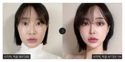 [강남언니 후기]  사각턱, 턱끝성형 한 달차 / 닉네임 : 곰돌이삼형제