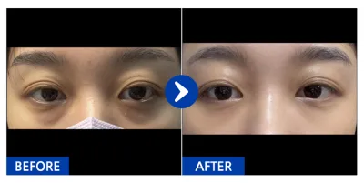 [바비톡] 눈밑지방재배치 / 1개월차 / 닉네임 : 눈눈엉옹