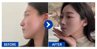 [바비톡] 코성형 / 5개월차/ 닉네임:atmospe