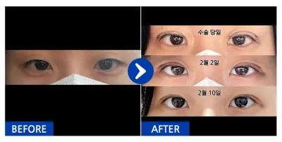 [강남언니] 자연유착 / 1개월차 / 닉네임 : 활쏴비아