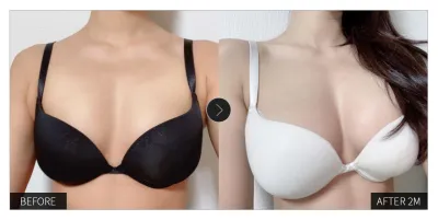 [강남언니 후기] 가슴성형 두 달차 / 닉네임 : 우우우나아