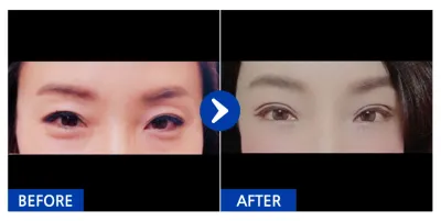 [강남언니] 상하안검 / 1개월차 / 닉네임 : JONABI555