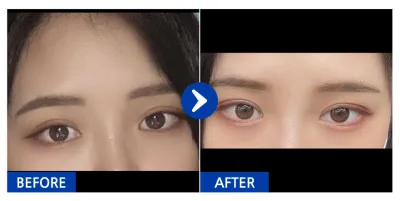 [강남언니] 자연유착 / 1개월차 / 닉네임 : 띠용ㅇㅅㅇ