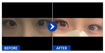 [바비톡] 눈밑, 쌍꺼풀(매몰) / 2개월차 / 닉네임 : 언이어니언디