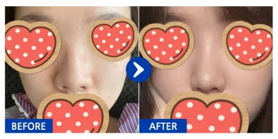 [강남언니] 코성형 / 1개월차 / 닉네임 : yyjk3396