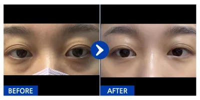 [강남언니] 눈밑지방재배치 / 1개월차/ 닉네임:이웃집요미