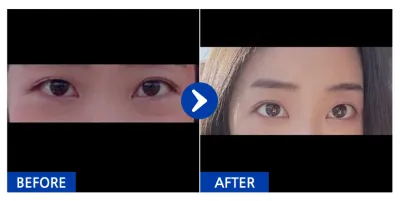 [바비톡] 눈밑지방재배치 / 1개월차 / 닉네임 : kd31