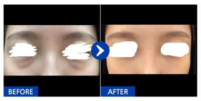 [바비톡] 눈밑지방재배치 / 1개월차 / 닉네임 : 슈슈슈슉슉