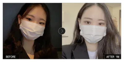 [강남언니 후기]  눈성형 한 달차 / 닉네임 : 내눈이니눈