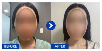 [바비톡] 안면윤곽 / 1개월차 / 닉네임 : 윰대딩