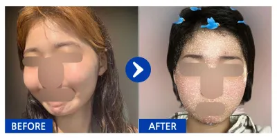 [바비톡] 안면윤곽 / 1개월차 / 닉네임 : 이이으루루루