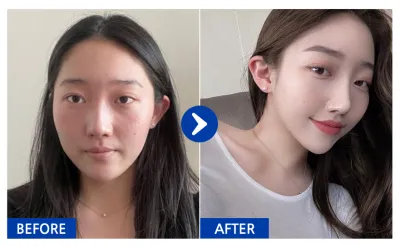 [바비톡] 코성형(기능코+미용코) / 2개월차 / 닉네임 : atmospe