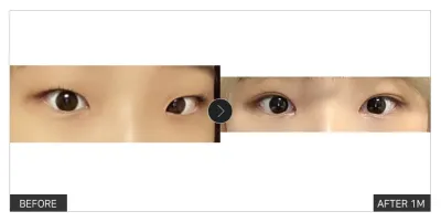 [강남언니 후기]  눈성형 한 달차 / 닉네임 : meyh