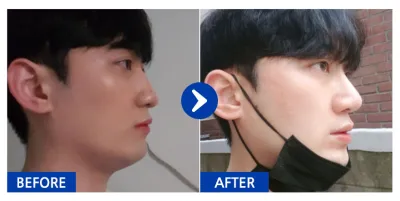 [강남언니] 코성형 / 6개월차 / 닉네임 : 핵규