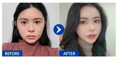 [강남언니] 지방이식 / 5달차 / 닉네임 : ooaa.a