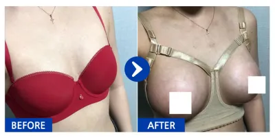 [바비톡] 가슴성형 / 2주차 / 닉네임 : 에이미언냐