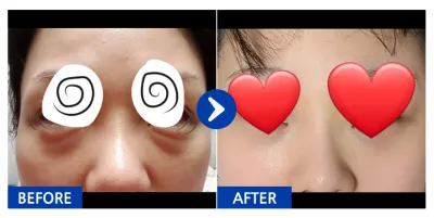 [강남언니] 눈밑지방재배치 / 3개월차 / 닉네임:냐옹홍