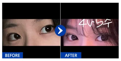 [강남언니] 눈성형 / 1개월차 / 닉네임 : 민트초코버븍티