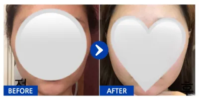 [강남언니] 안면윤곽 / 1개월차 / 닉네임: daldal2