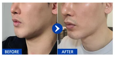 [바비톡] 얼굴지방흡입 / 2개월차 / 닉네임:굼붕어