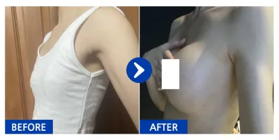 [강남언니] 가슴(모티바) / 1개월차 / 닉네임:초록허브