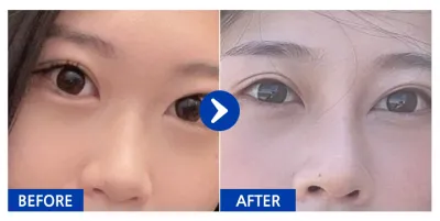 [강남언니] 코성형 / 2개월차 / 닉네임:옹츄