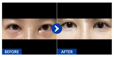 [강남언니] 눈밑지방재배치 / 1개월차 / 닉네임:anjjjjjjj